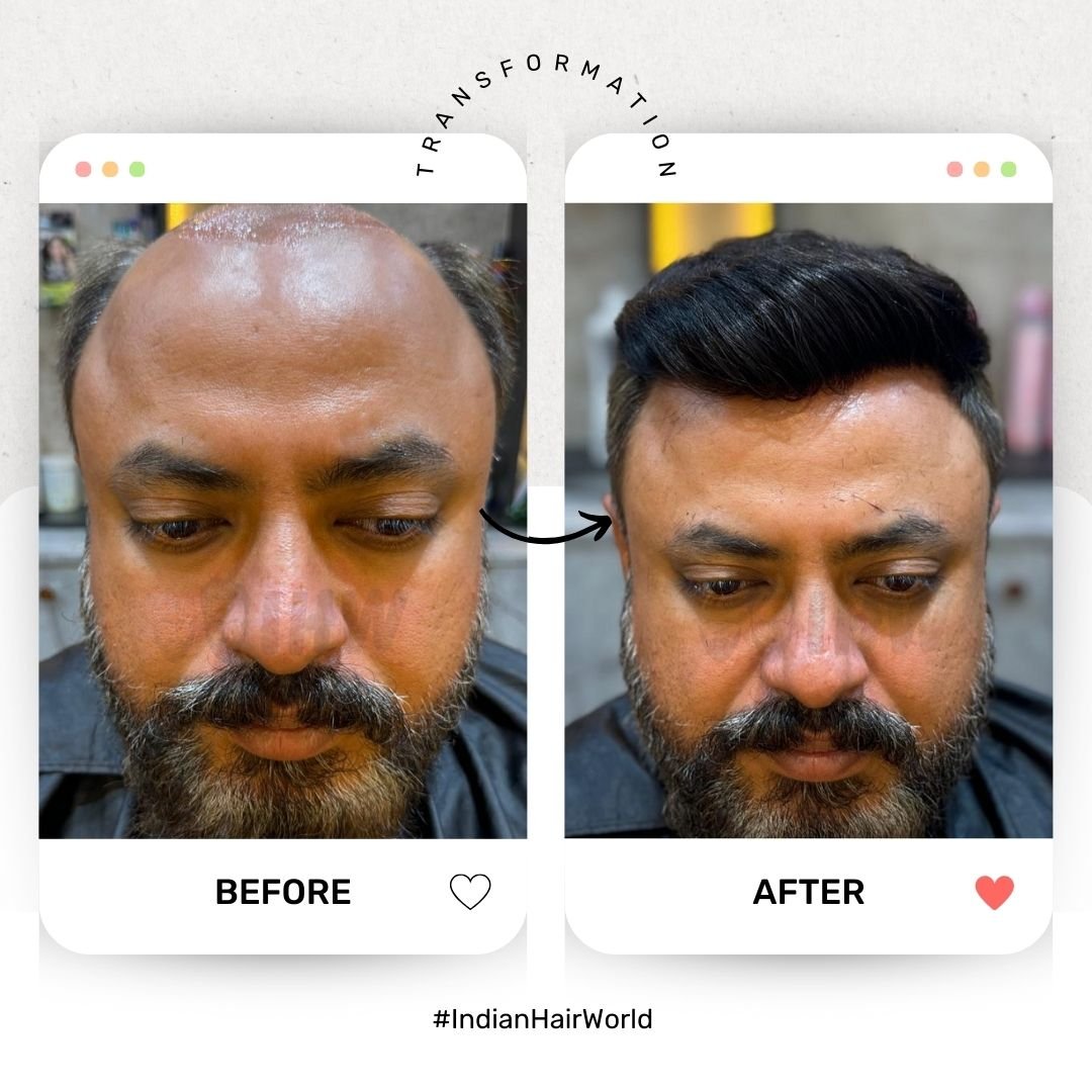 Best Hair Replacement Service Kolkata