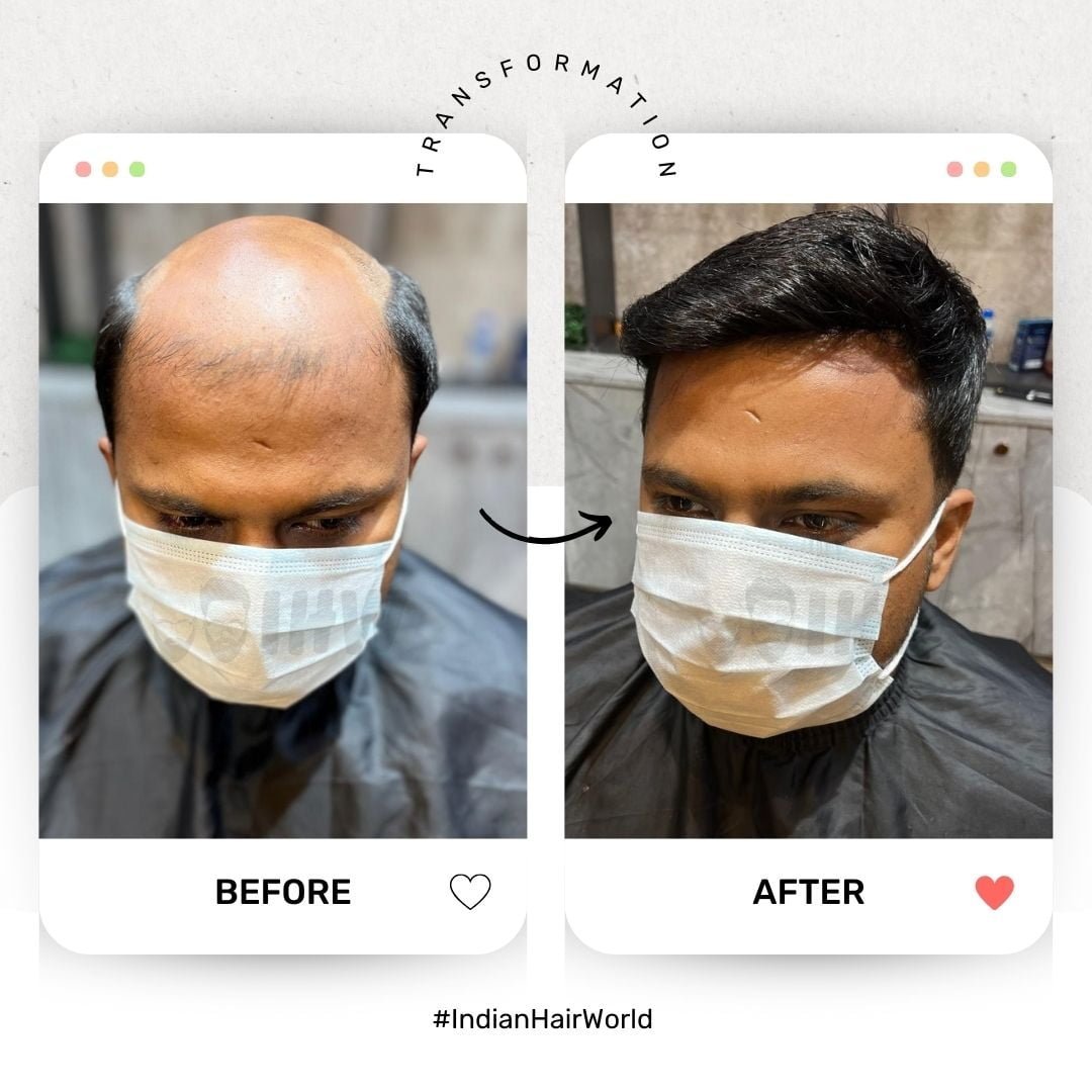 Say Goodbye to Baldness: The Complete Guide to Hair Patches & Non-Surgical Hair Replacement