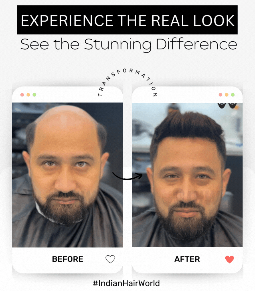 Copy of #IndianHairWorld Best Hair Replacement Service Kolkata
